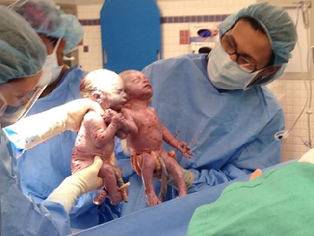 Estas gemelas nacieron cogidas de la mano, ¿cómo estarán 6 meses después?